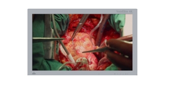 SURGICAL DISPLAYS Ventless and integrated decoder